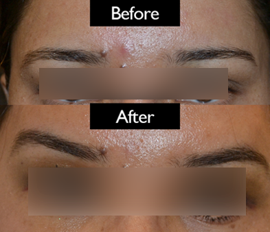 brow-patient3